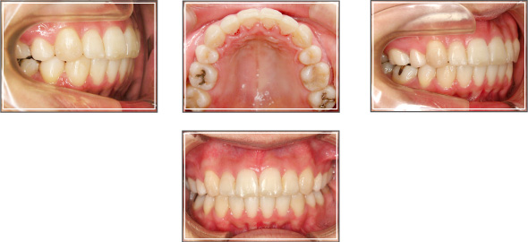 リンガル(裏側）矯正治療例1