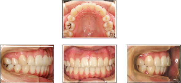 リンガル(裏側）矯正治療例1