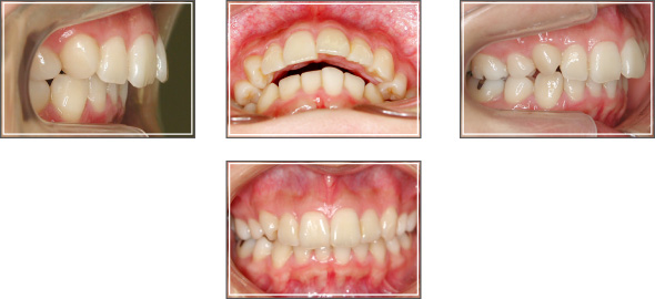 リンガル(裏側）矯正治療例1